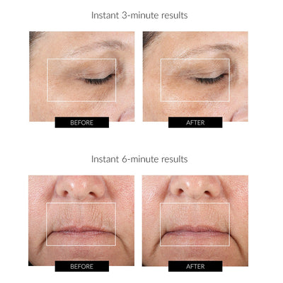 NuFACE FIX Line Smoothing Device Before and After Review